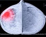 'HER2 양성 유방암'에 표적치료제 '엔허투' 효과 탁월(연구)