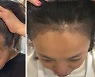 34세 배우 고은아 "이마에 모발 3000모 심었어요"