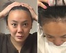 고은아 '모발이식 3000모' 고백.."34년 소원, 올백하겠다"