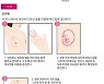 슬기로운 의사들도 피해가지 못했던 '젊은 유방암' 주의해야