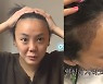 "나도 머리 심었어요"..모발 이식하면 탈모 멈출까? [건강!톡]