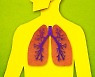 담배도 피우지 않는데 마른 기침·피로 생기는 희소 질환 '사르코이드증'