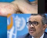WHO, 원숭이두창 비상사태 선포 '저울질'