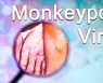 '원숭이 두창' 바이러스 진단키트 개발 활발..출시 시점은 '몰라'