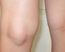 무릎 뒤쪽에 혹이 생기는 이 질환은 무엇?