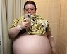"아이 10명 임신한 느낌"…47kg '난소낭종' 제거한 20대 여성